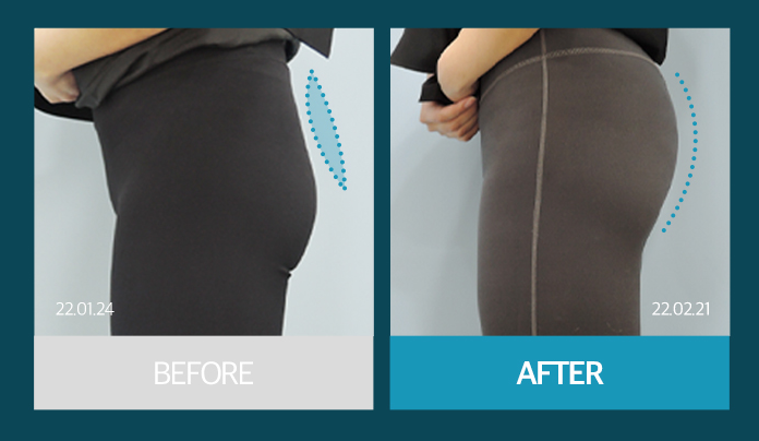Why Butt-Only Workouts Aren't Enough｜When Hip Fillers Are Needed for Hip Dips image 30