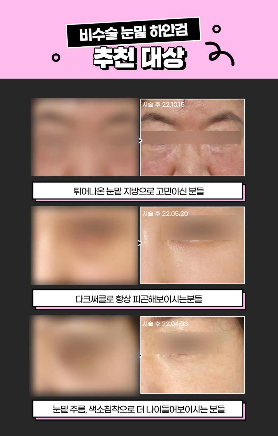 눈밑노화, 비수술 비절개 눈밑하안검으로 관련 이미지 7