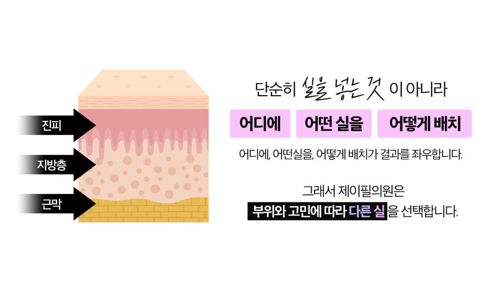실리프팅 전문병원 선택 기준 총정리 ㅣ 실 종류&middot;디자인&middot;노하우&middot;의료진 경험 관련 이미지 3