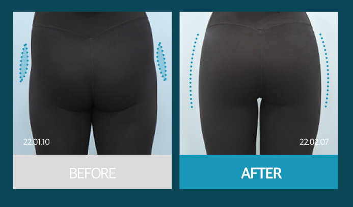 Why Butt-Only Workouts Aren't Enough｜When Hip Fillers Are Needed for Hip Dips image 31