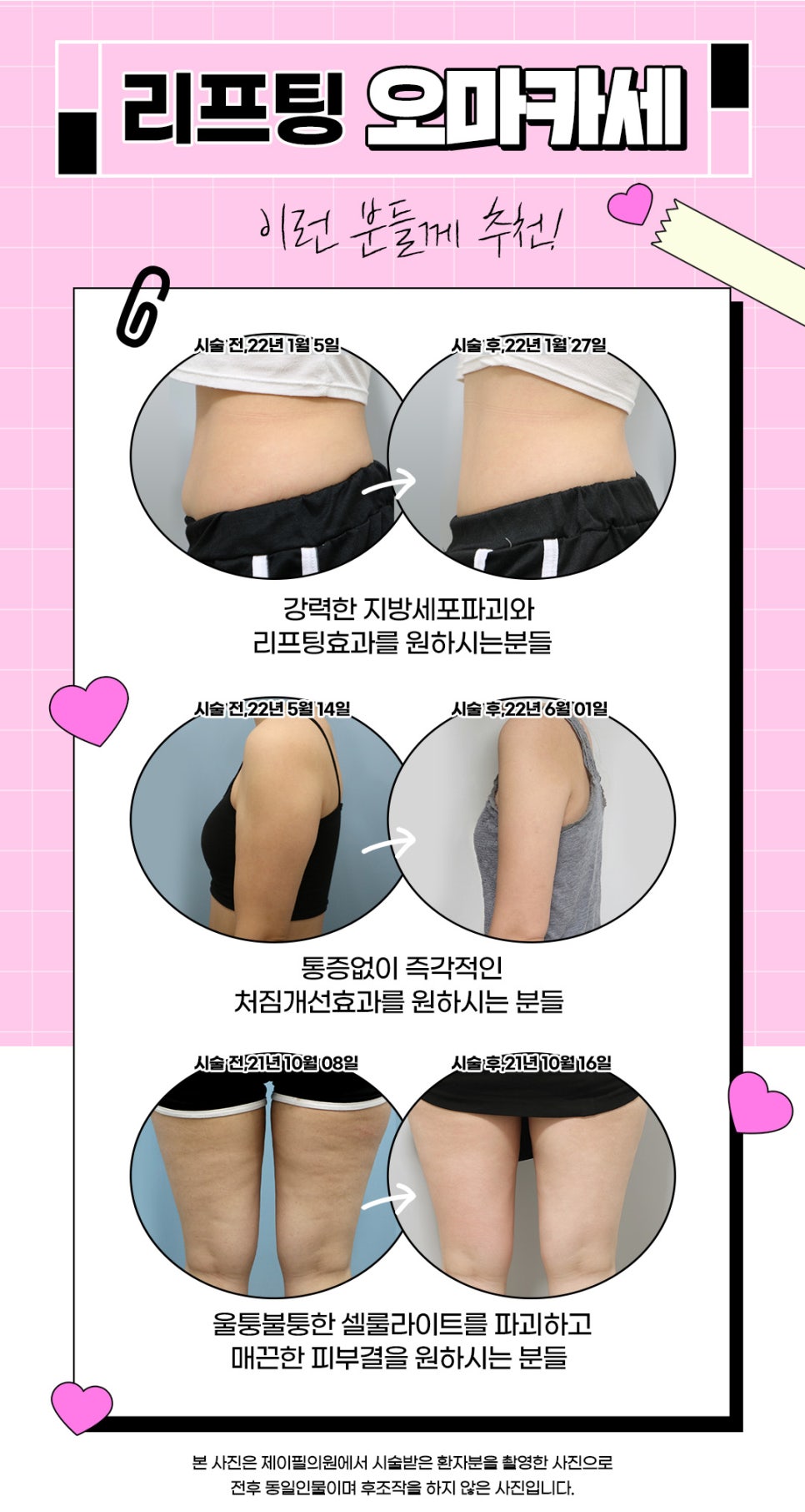 바디리프팅으로 처진 살, 셀룰라이트 해결 관련 이미지 3