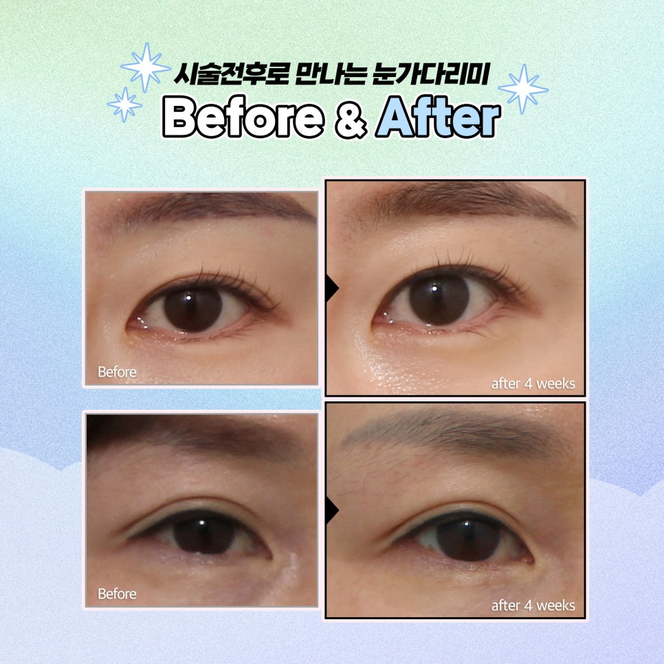 눈가관리, 무통증 눈가다리미로 해결 관련 이미지 7