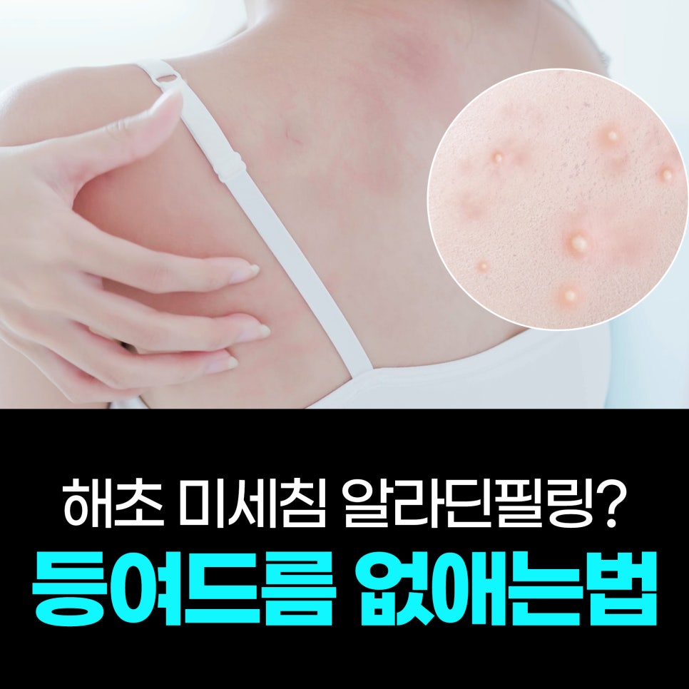 등 여드름 없애는법, 여름 등드름 고민엔 해초 미세침 알라딘필링? 관련 이미지 1