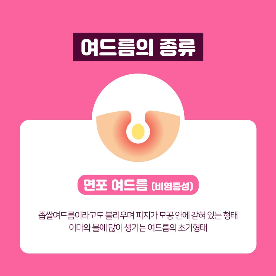 화농성여드름에도 탁월한 여드름레이저 관련 이미지 5