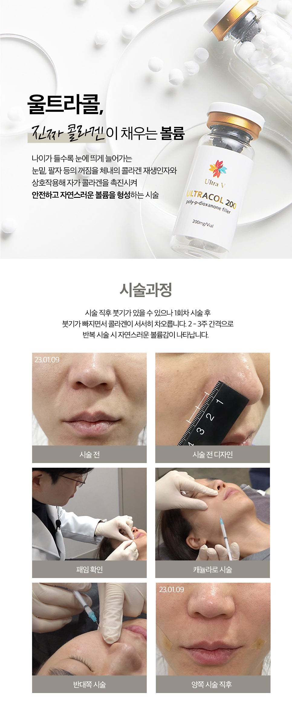 홍대울트라콜, 빈틈없는 콜라겐 필러 관련 이미지 3
