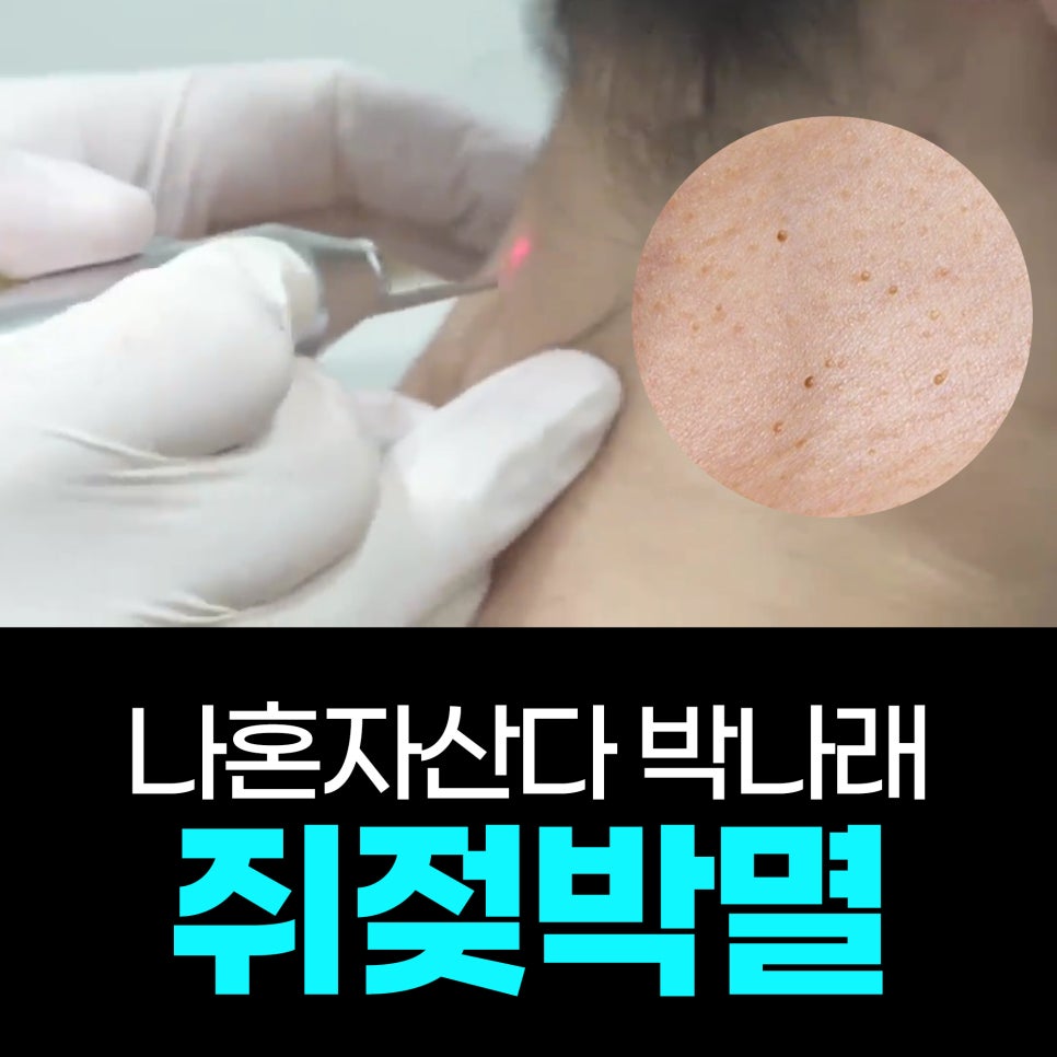 나혼산 박나래 쥐젖제거 홍대 쥐젖 피부과 얼굴 목 쥐젖 제거 비용 관련 이미지 1