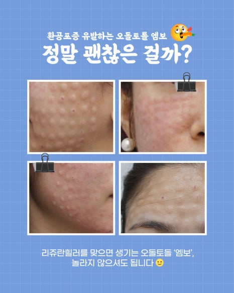 The Key to the Clean Girl Skin Routine | A Complete Guide to Rejuran, 5 Lasers, and Titanium image 9