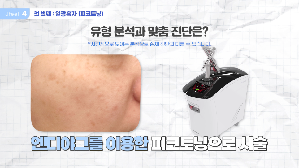 홍대 피부과 기미 잡티제거 레이저 및 구분법 관련 이미지 11