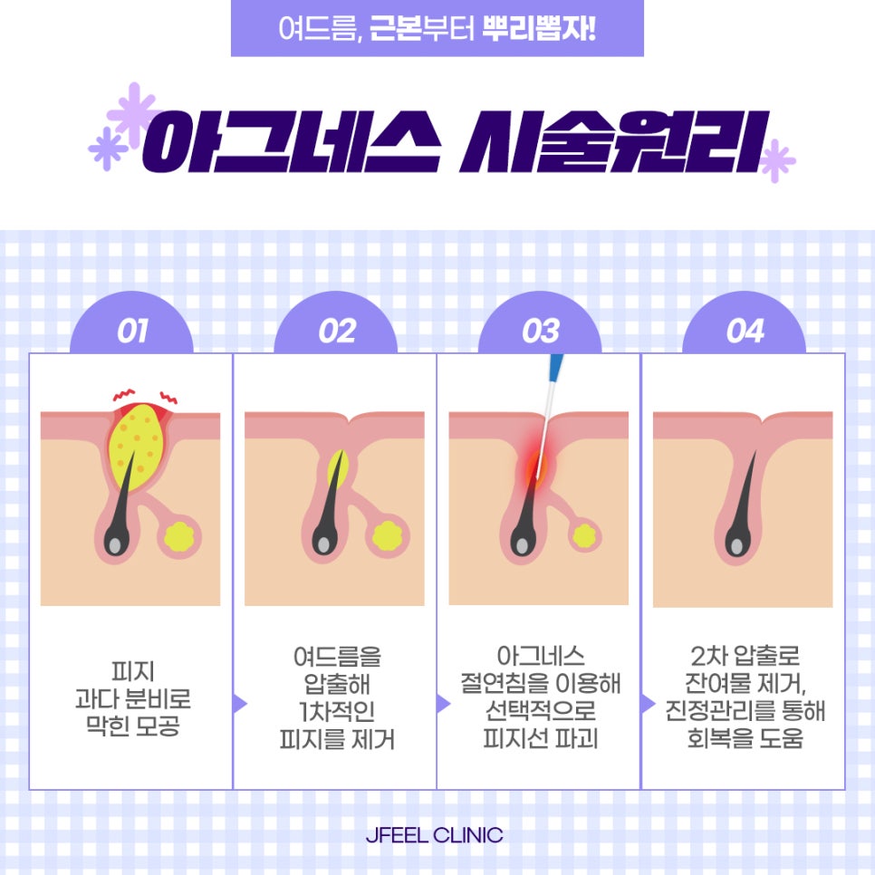 마스크트러블,마드름 제대로된 여드름치료는 아그네스로 관련 이미지 2