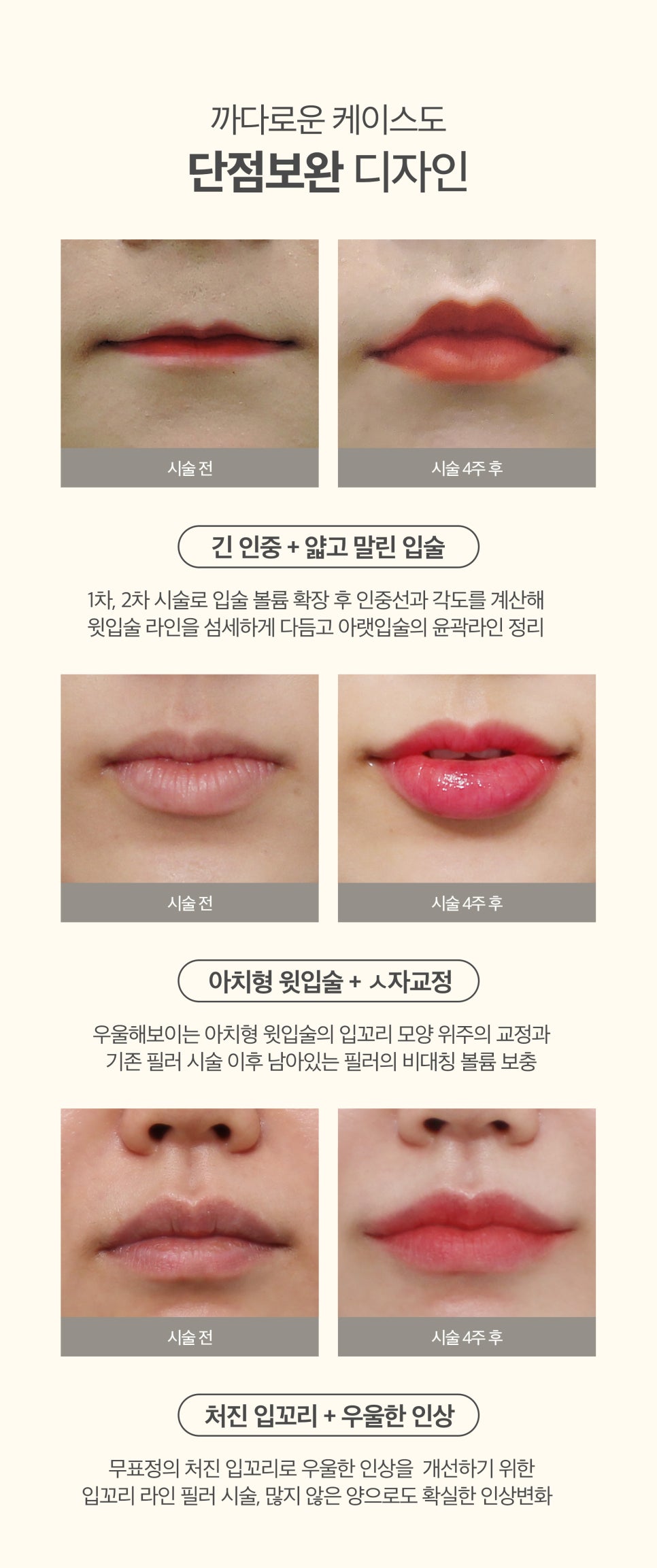 입술전체필러로 탱글 볼륨 만들기 관련 이미지 4