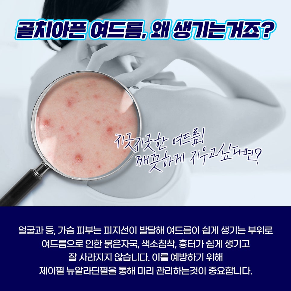 등드름, 가슴여드름 관리는 홍대피부과 뉴알라딘필링! 관련 이미지 2