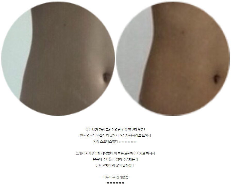 옆구리살빼는법 홍대지방분해주사 퀸주사 후기 관련 이미지 3
