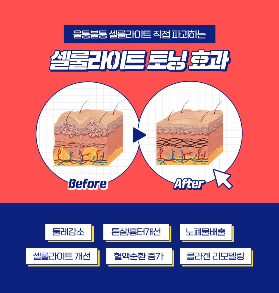잡았다! 셀룰라이트 없애는 법, 제이필 셀룰라이트 토닝으로! 관련 이미지 3