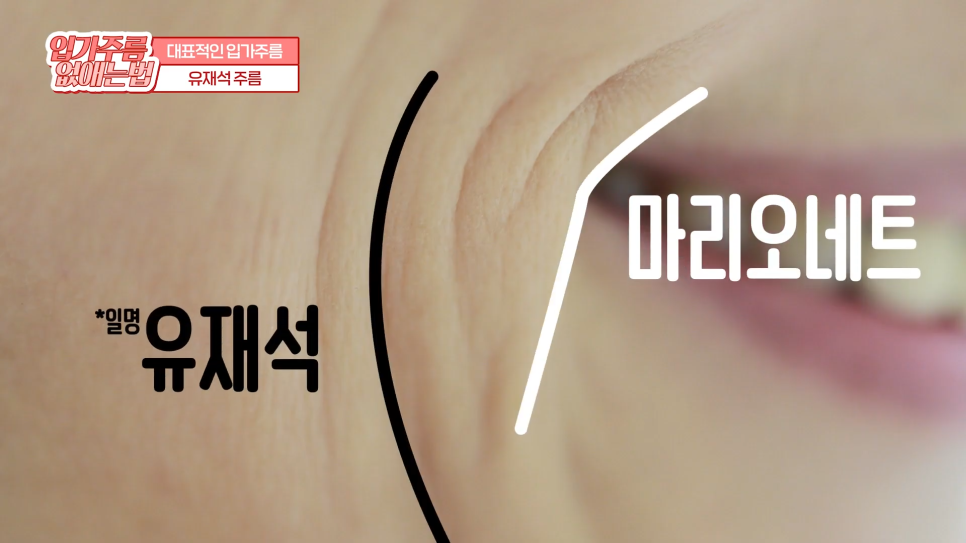입가주름시술, 원인부터 치료, 예방까지 한 번에 관련 이미지 13