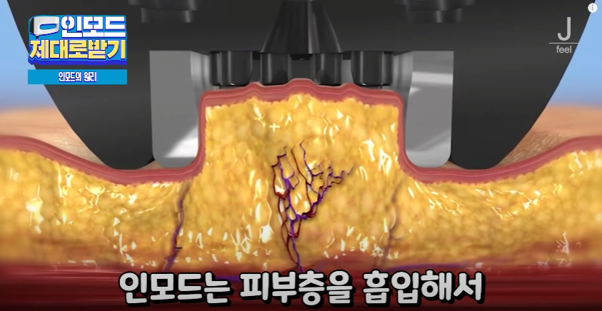 인모드효과 못 보셨다면 여기로 관련 이미지 2