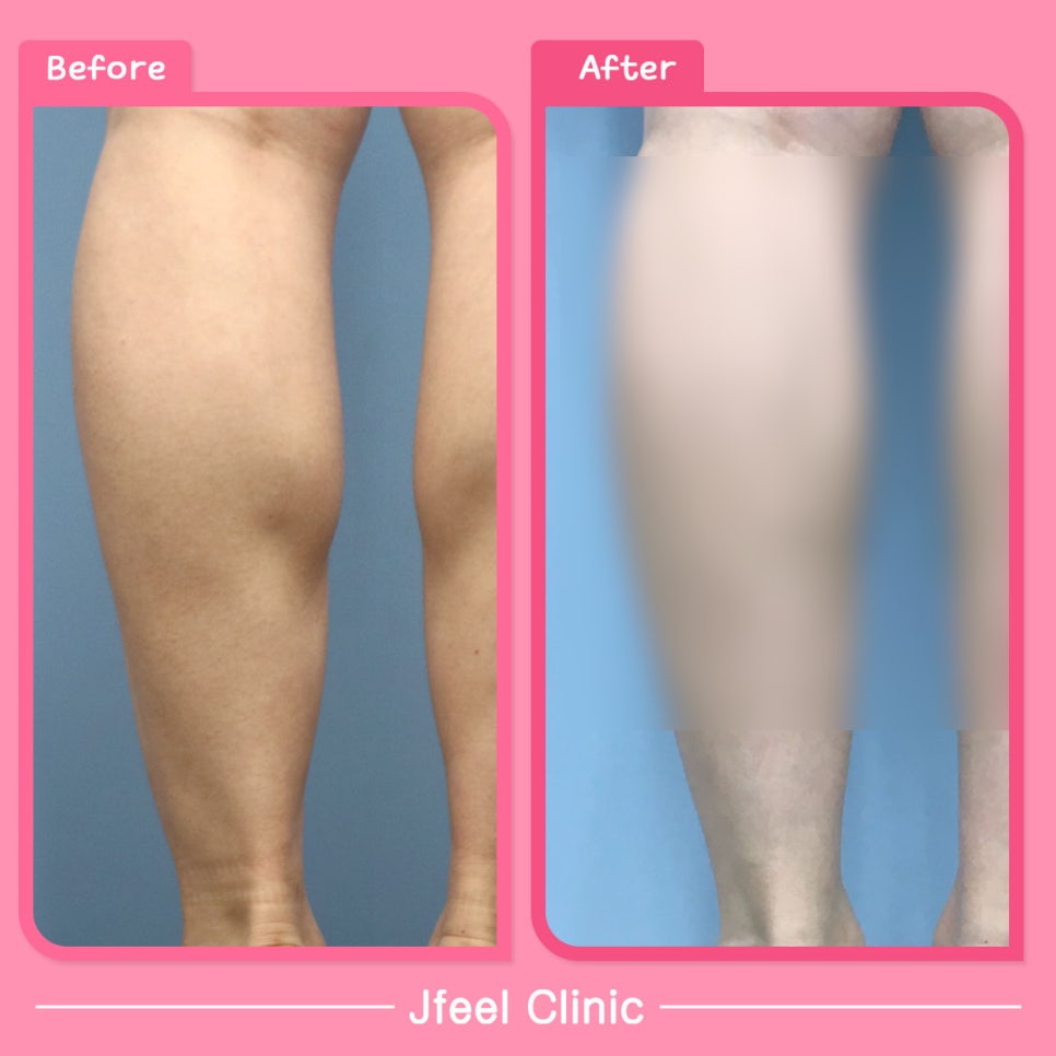 종아리붓기, 부종, 뭉침, 알 등 근육형 하체 비만도 다리가 얇아질 수 있을까요? 관련 이미지 1
