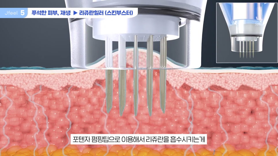 3O대피부과시술 3가지 추천 관련 이미지 14