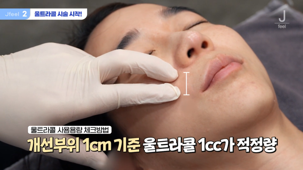 필러가 싫다면? 눈가, 팔자, 주름 해결하는 울트라콜 관련 이미지 9