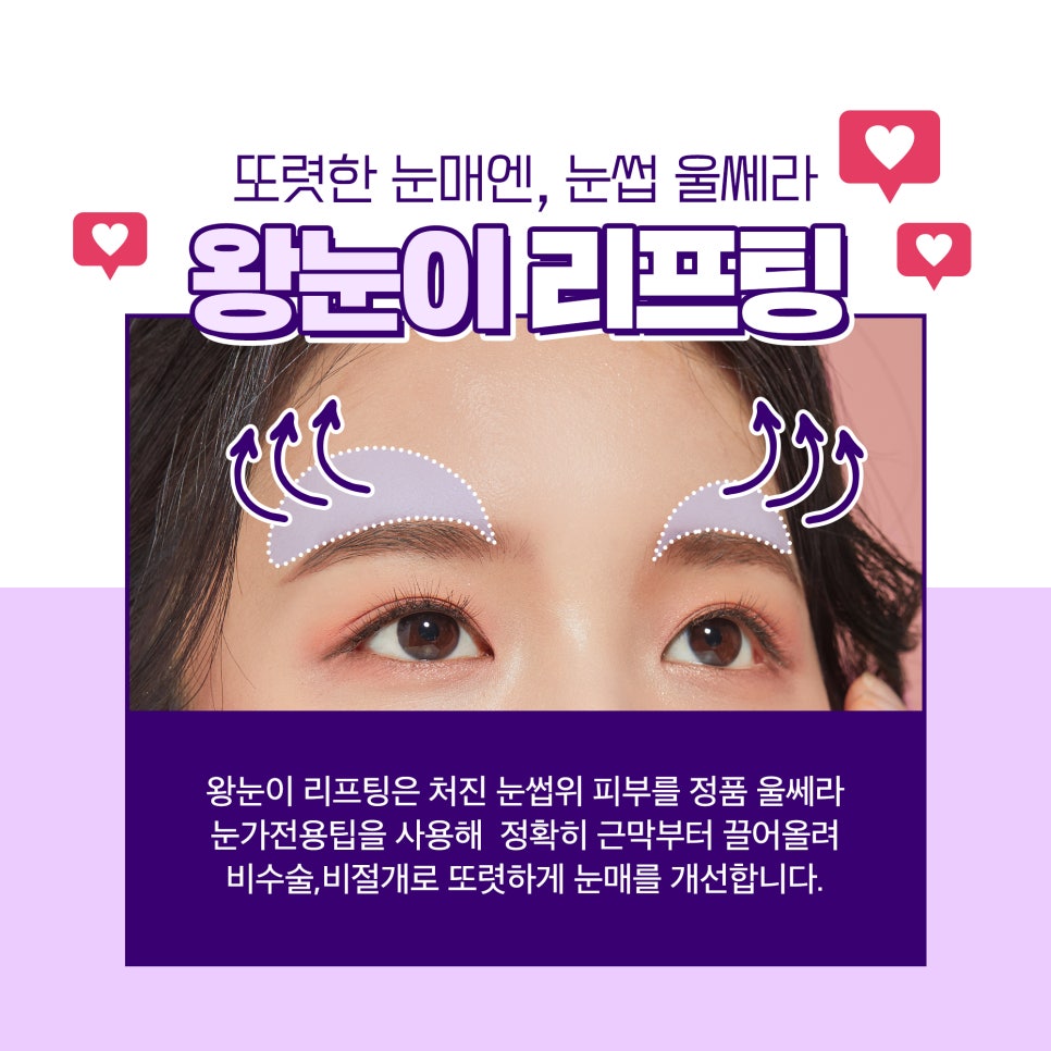 비절개 비수술로 눈두덩지방제거&눈매교정! 관련 이미지 3