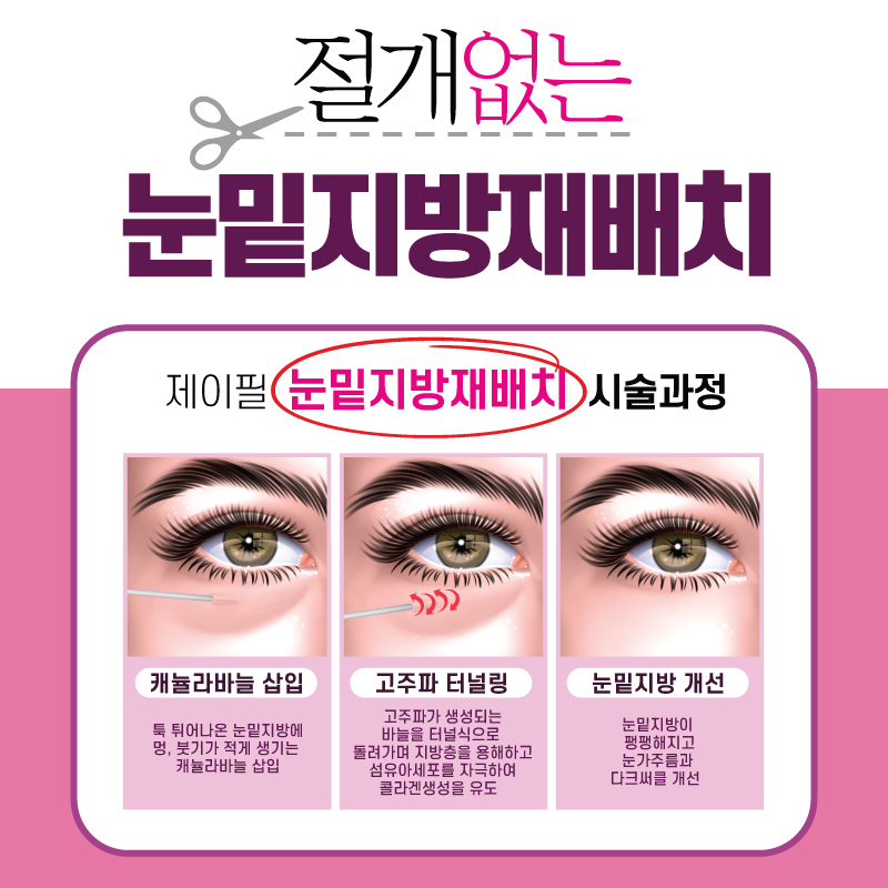 [홍대피부과] 눈밑지방재배치 수술없이 레이저로 다크서클, 눈밑지방 고민 해결! 관련 이미지 2