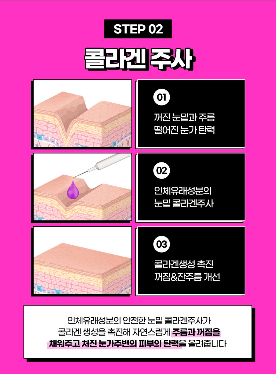 눈밑노화, 비수술 비절개 눈밑하안검으로 관련 이미지 5