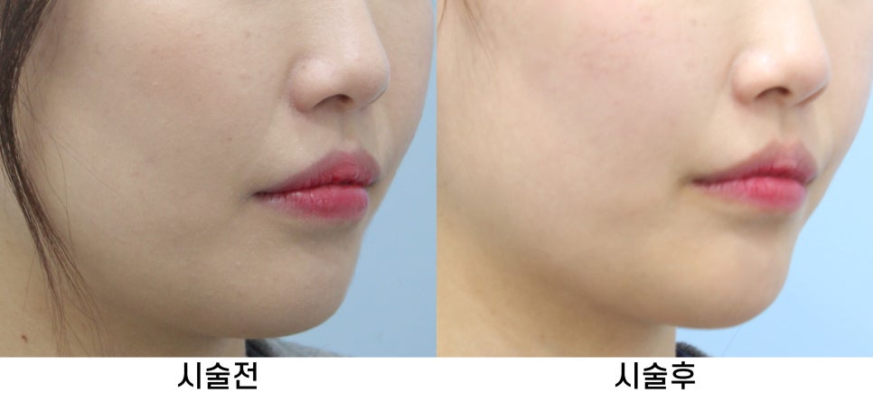 [홍대피부과] 제이필의원의 갸름한 턱라인 무턱필러 관련 이미지 5