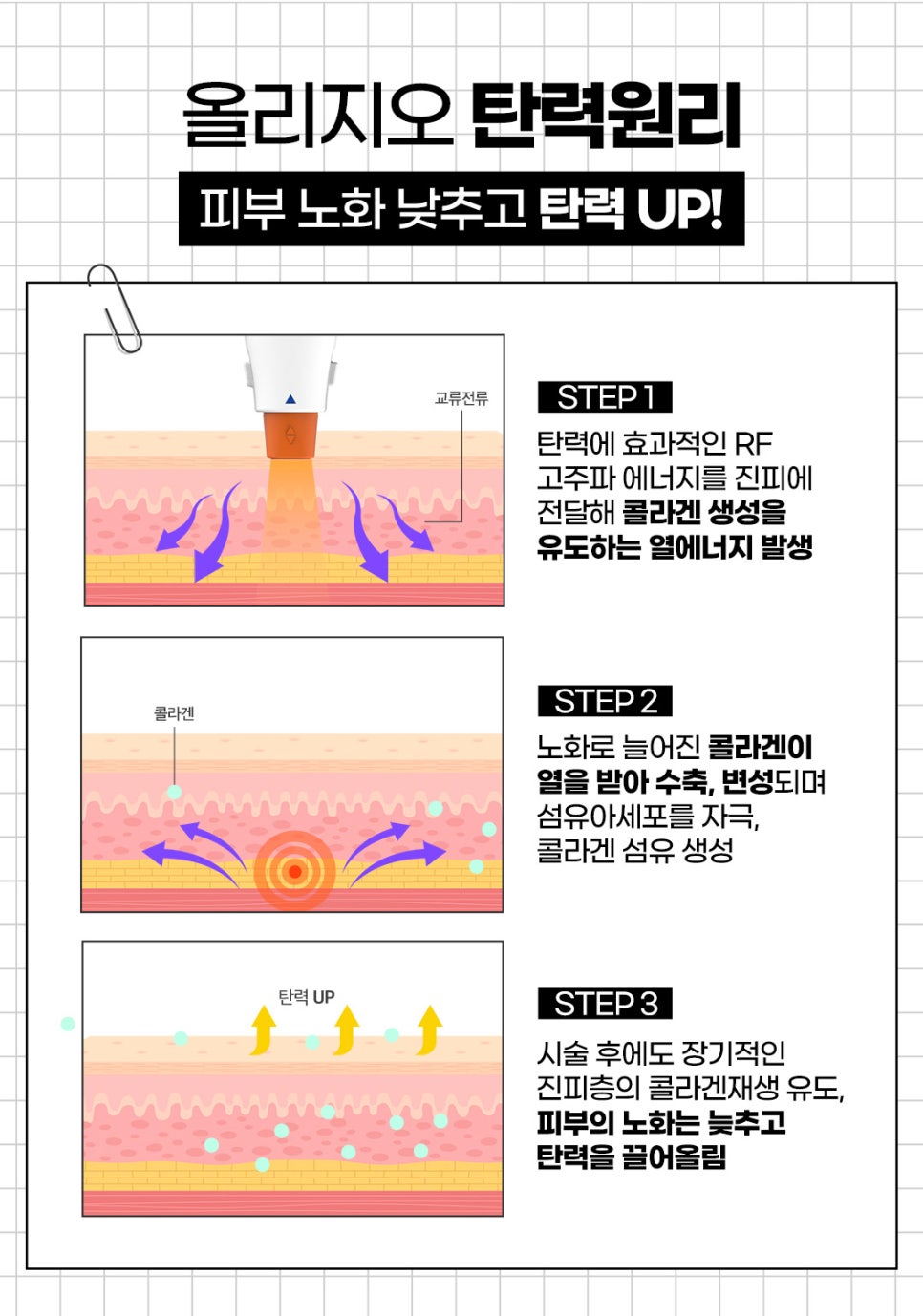 눈밑주름레이저 아이올리지오는 제이필의원에서 관련 이미지 7
