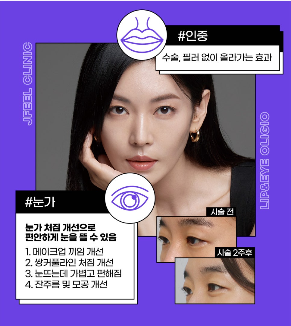 눈밑주름레이저 아이올리지오는 제이필의원에서 관련 이미지 6