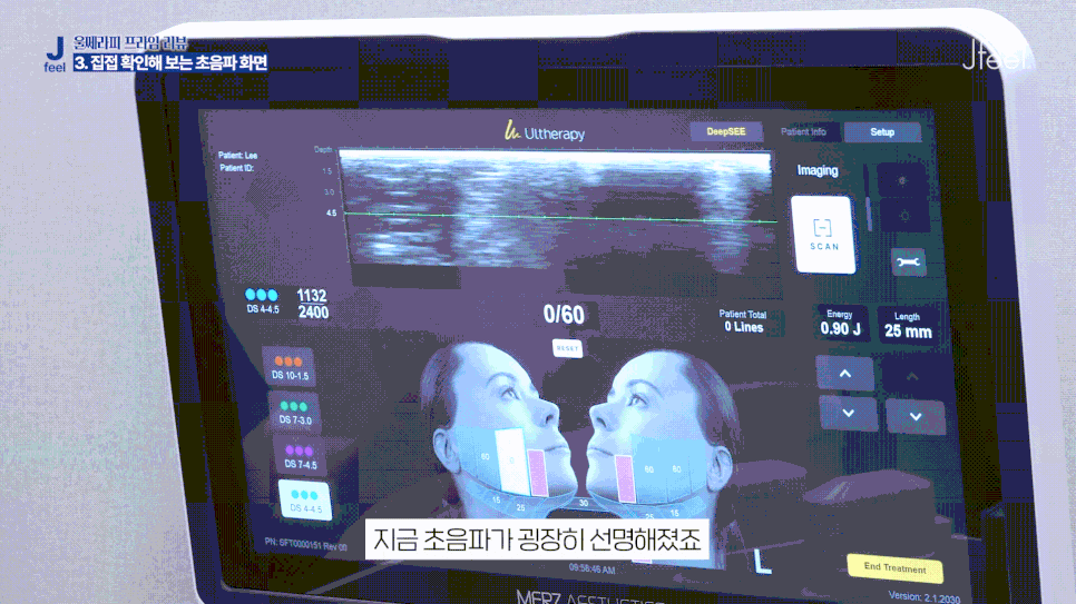 울쎄라피 프라임, 기존 울쎄라와 다른 점은? 울쎄라 탑 트레이너가 알려드립니다. 관련 이미지 9
