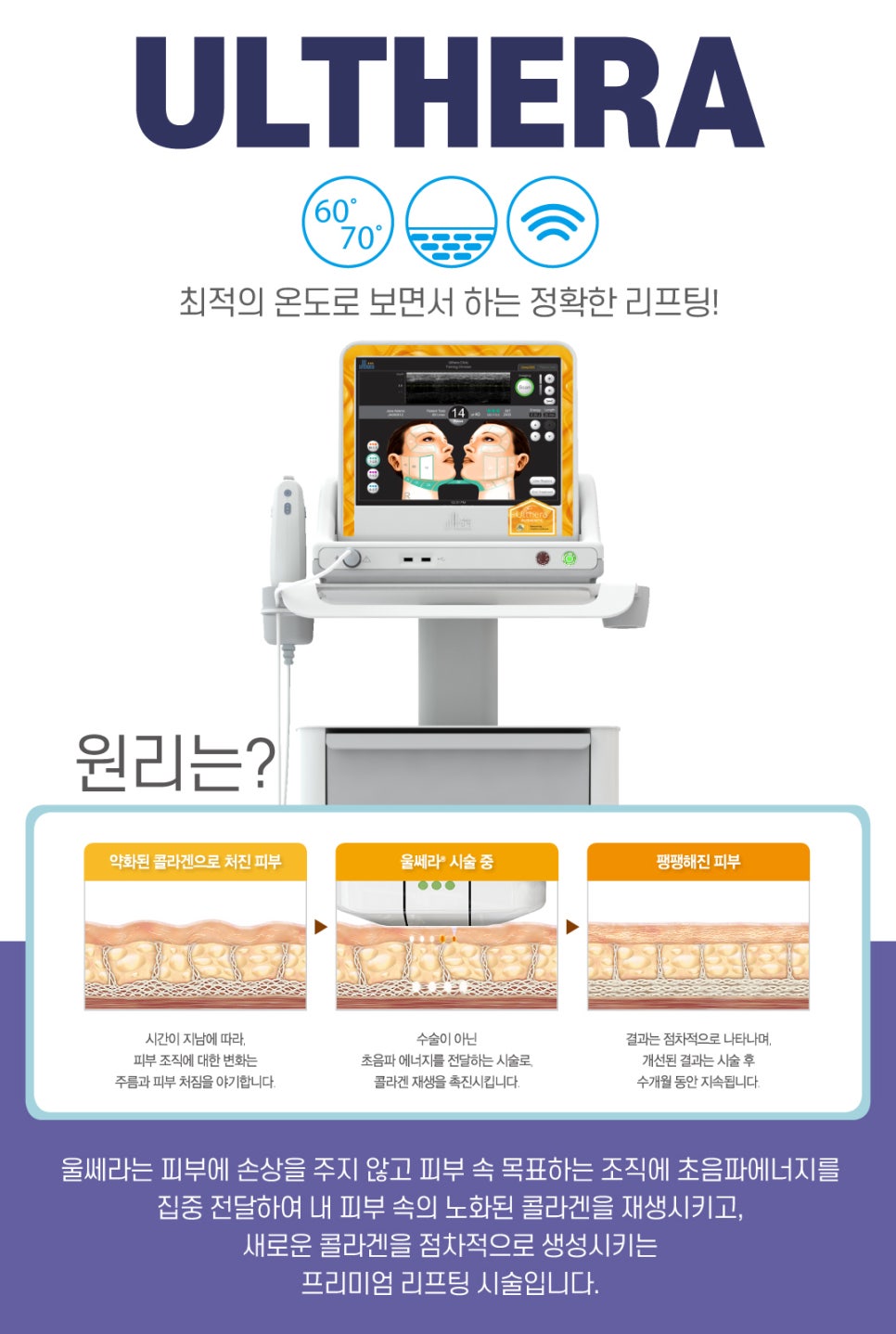 [홍대피부과]울쎄라(Ultherapy)는 제이필! 슈링크 잘하는 곳이, 울쎄라도 잘한다. 관련 이미지 3