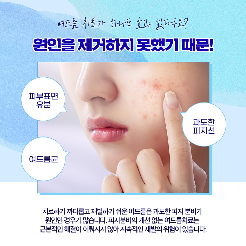 피지억제 레이저로 기름진 얼굴 여드름 STOP 관련 이미지 2