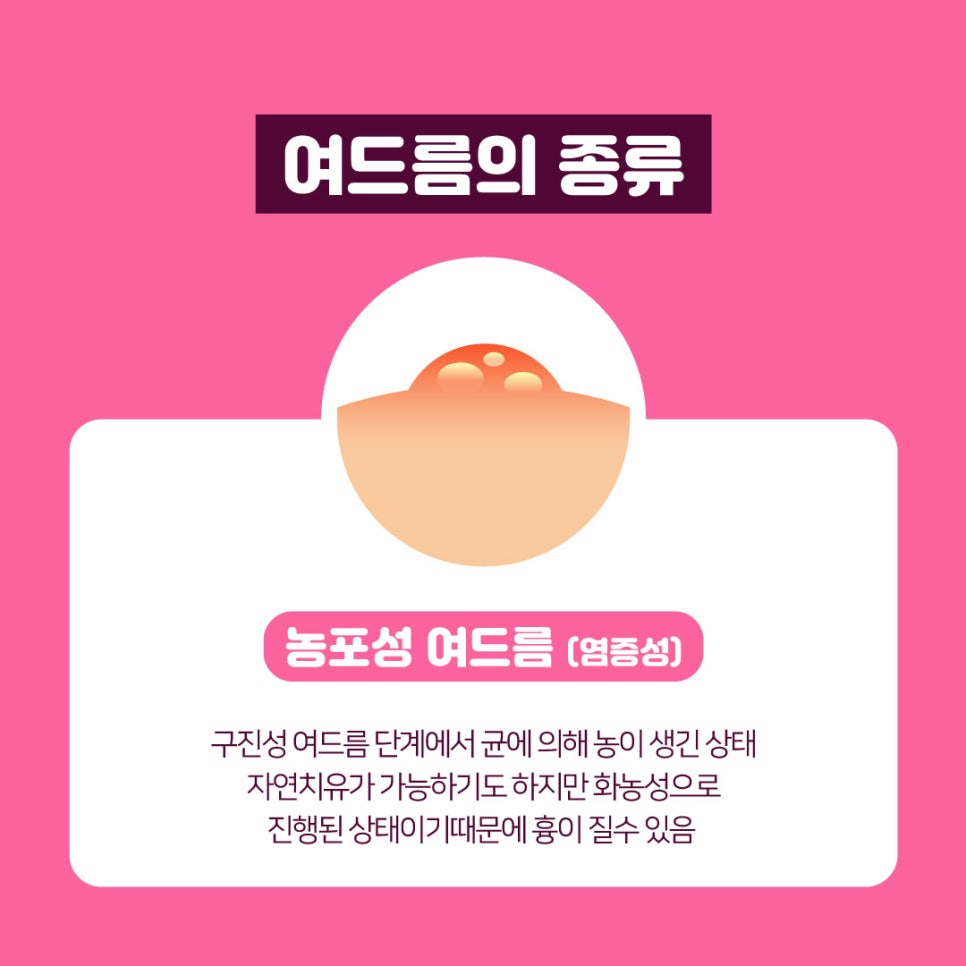 화농성여드름에도 탁월한 여드름레이저 관련 이미지 7