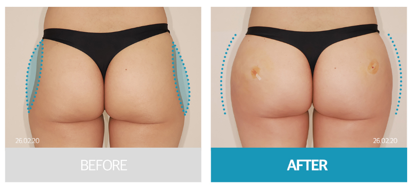 Why Butt-Only Workouts Aren't Enough｜When Hip Fillers Are Needed for Hip Dips image 10