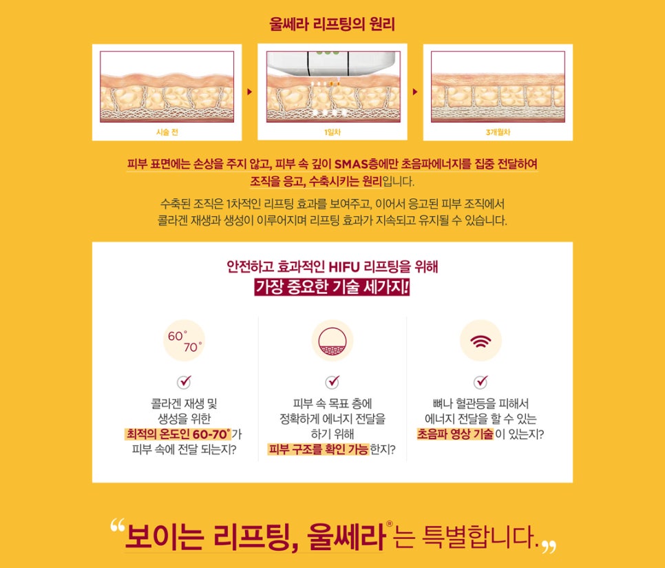 [홍대피부과] 결과가 다른 제이필의 정품 울쎄라 !! 관련 이미지 2