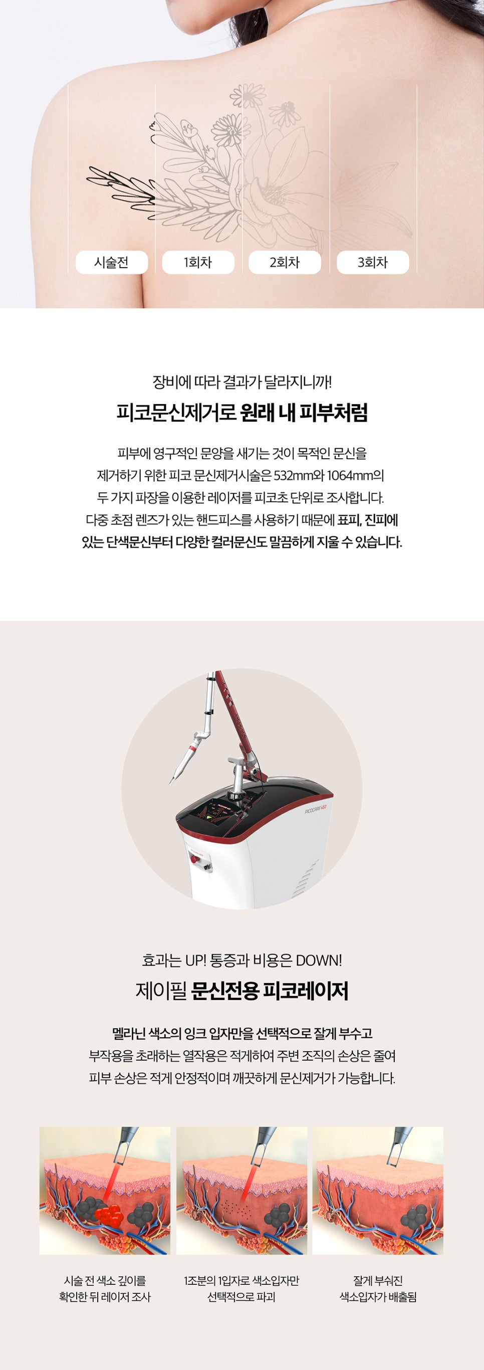 미니타투제거는 피코문신제거 레이저 관련 이미지 2