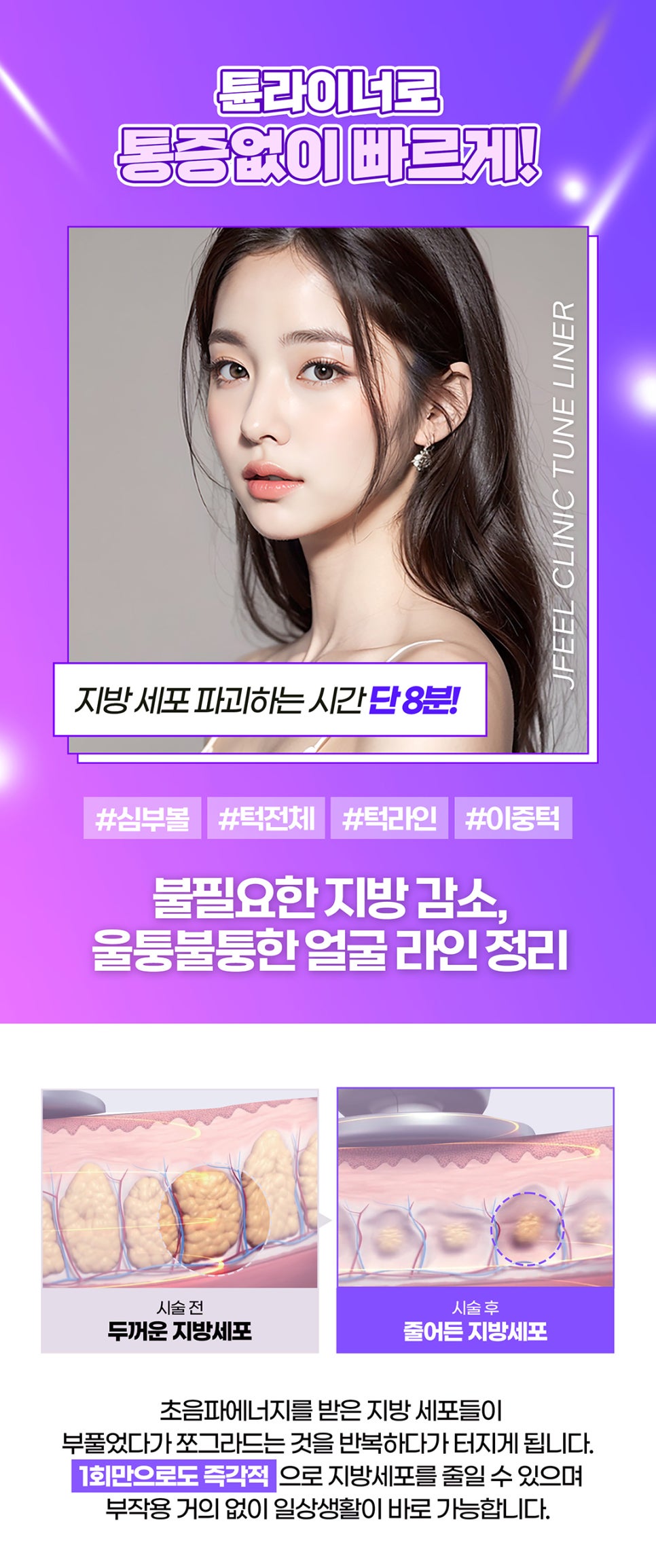 V라인시술로 지방 파괴를 원한다면 관련 이미지 5