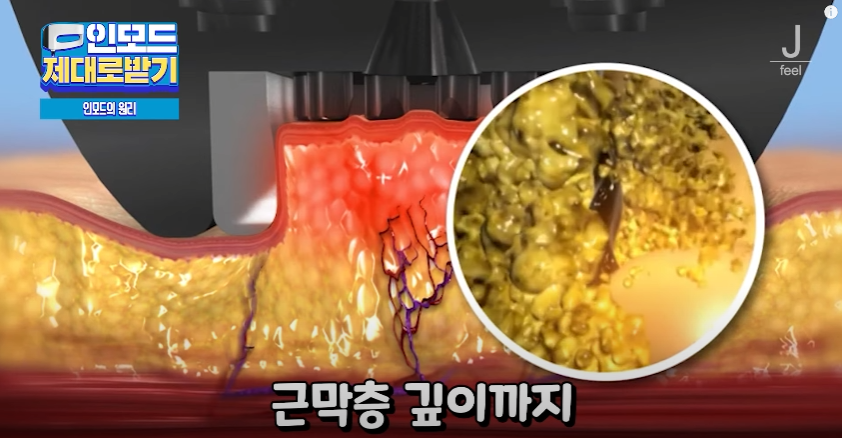 인모드효과 못 보셨다면 여기로 관련 이미지 6