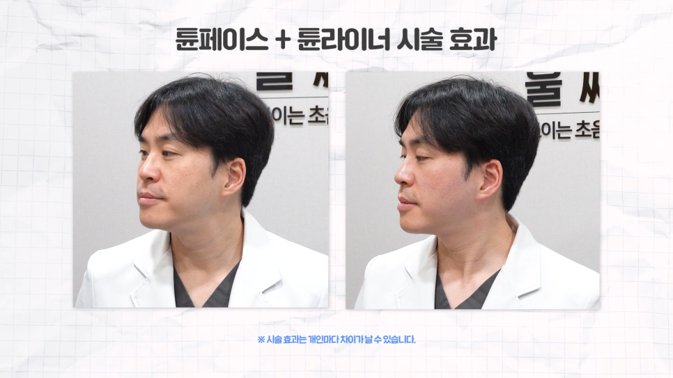 얼굴라인 30분 만에 완성, 튠페이스 튠라이너 관련 이미지 8