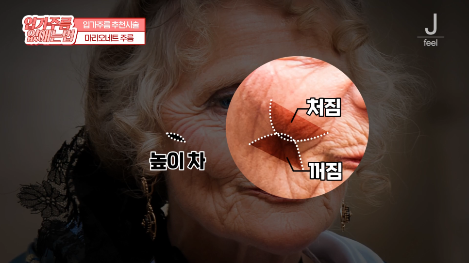입가주름시술, 원인부터 치료, 예방까지 한 번에 관련 이미지 10