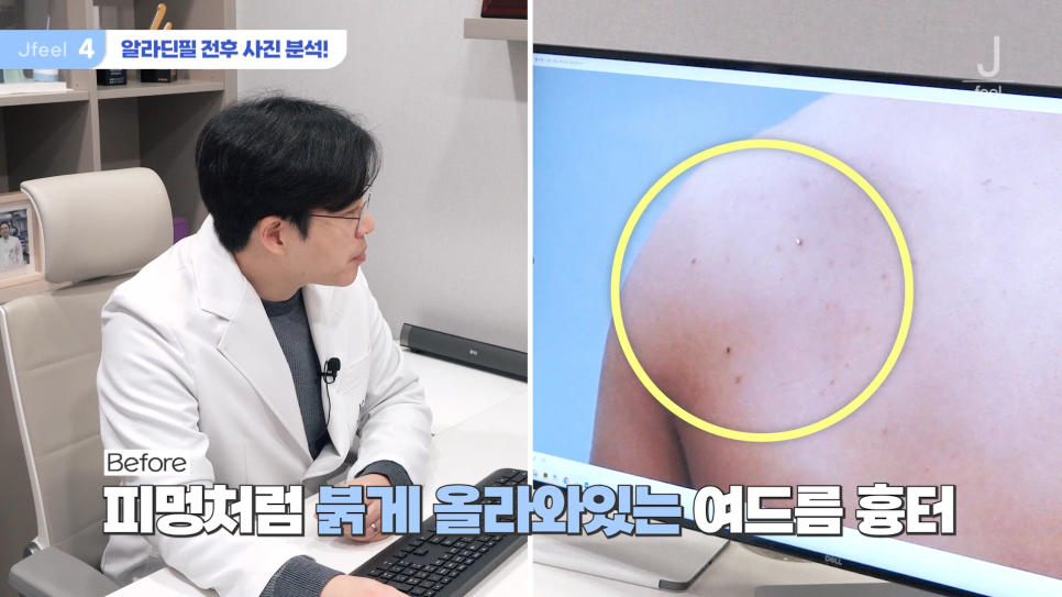 등여드름필링으로 연예인 등 만들기 관련 이미지 14