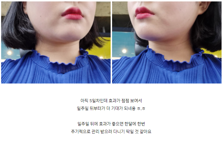 이중턱, 심부볼 윤곽주사 스테로이드 없는 후아유 후기 관련 이미지 3