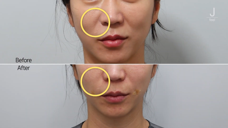 필러가 싫다면? 눈가, 팔자, 주름 해결하는 울트라콜 관련 이미지 14