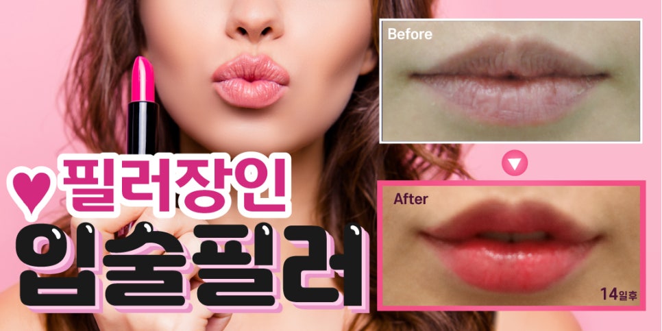 홍대피부과, 키스데이맞이 입술필러 이벤트 관련 이미지 10