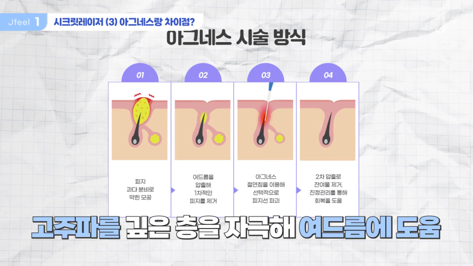 시크릿레이저, 인모드, 쥬베룩 인기 시술 Q&A 관련 이미지 9