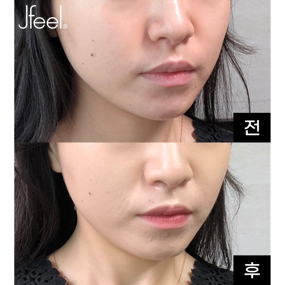 인모드리프팅 FX ,포르마 후기&hearts; 효과시기 궁금하셨던 분들 주목! 관련 이미지 2