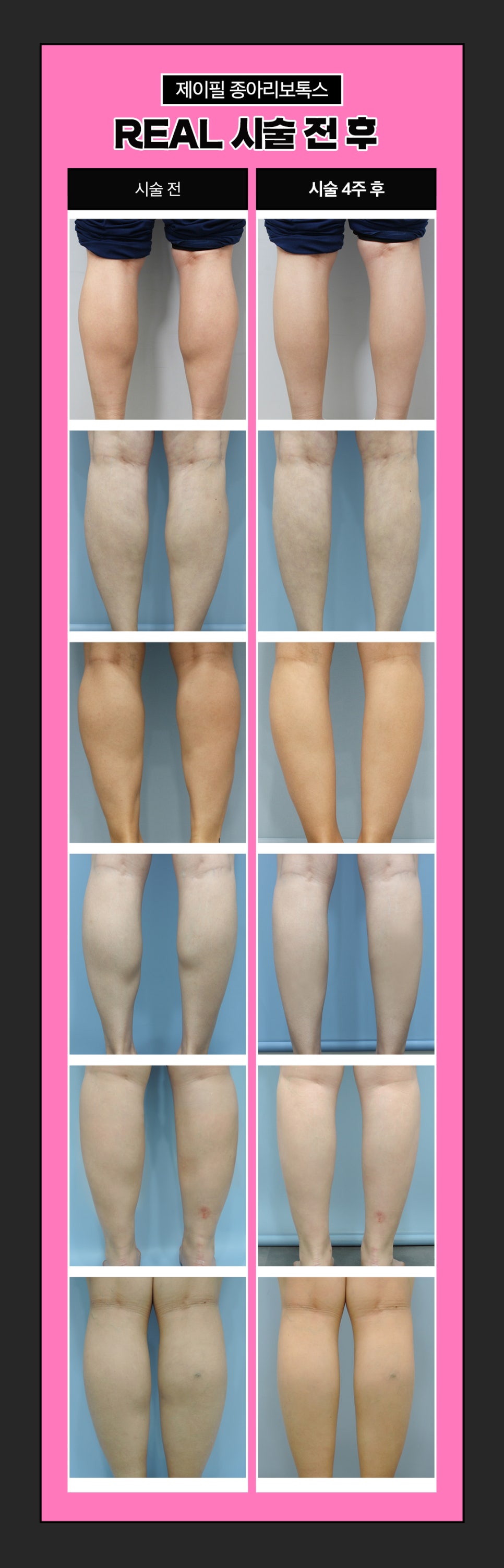 종아리알빼고 하체비만 탈출! 날씬한 다리만들어요 관련 이미지 6
