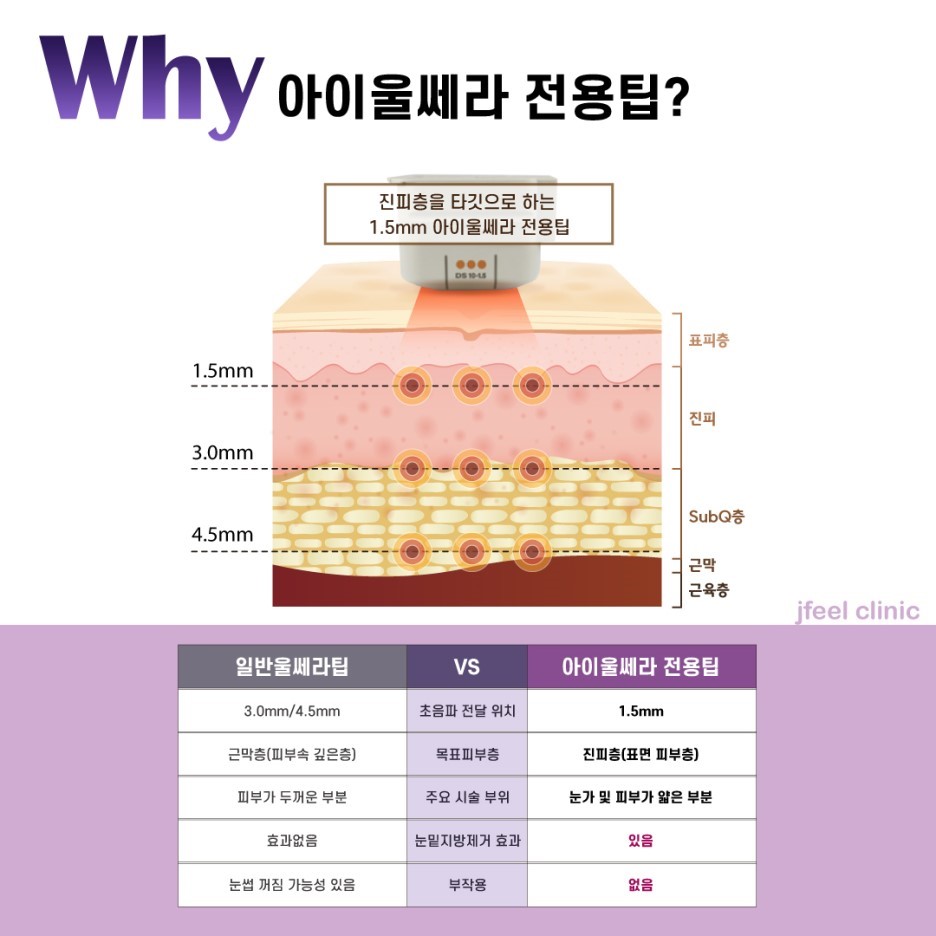 &ldquo;뚜렷한 눈&rdquo; 수술없이 주사로 1분이면 OK 눈두덩이 주사 관련 이미지 6