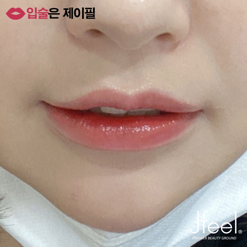 입술필러 맞고 조심해야 할 점, 주의사항, 통증, 붓기 관련 이미지 10