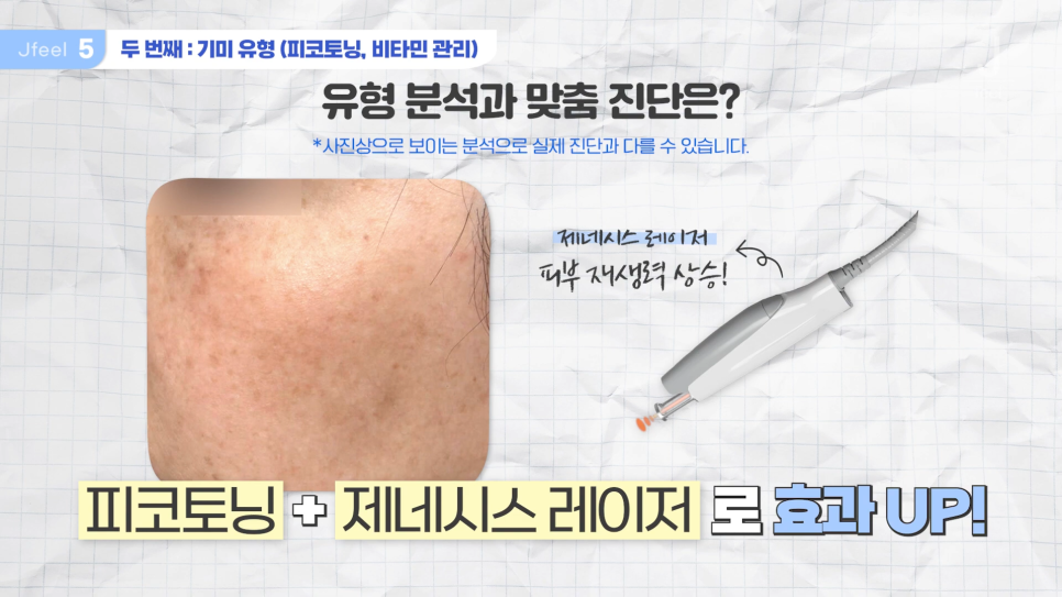 기미 주근깨 잡티에 이 시술만은 NO! 시술 전 필독 관련 이미지 11