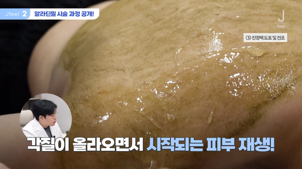 등여드름필링으로 연예인 등 만들기 관련 이미지 8